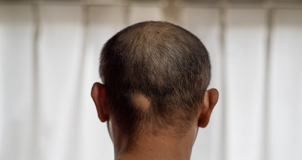 Patchy hair loss is one alopecia areata type It is a mild alopecia areata