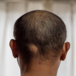 Patchy hair loss is one alopecia areata type