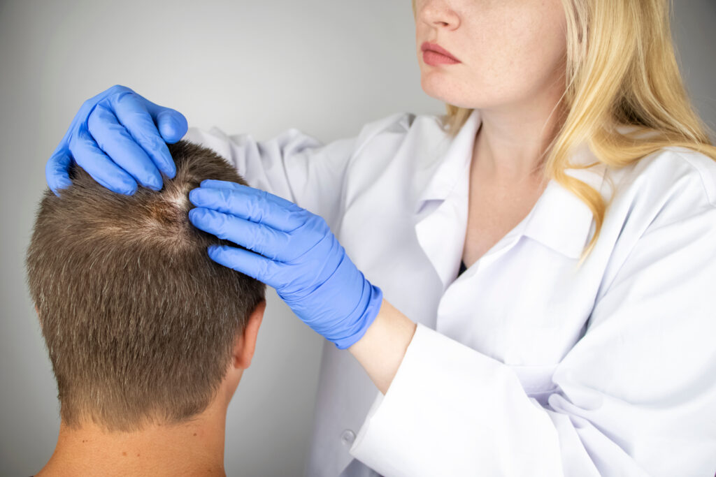 Dermatologist examining hair loss spot, possibly due to alopecia areata