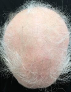 Diffuse alopecia areata