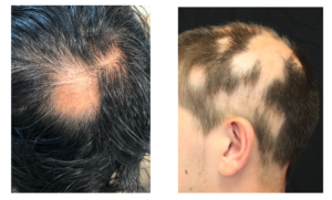 Two images of one alopecia areata type